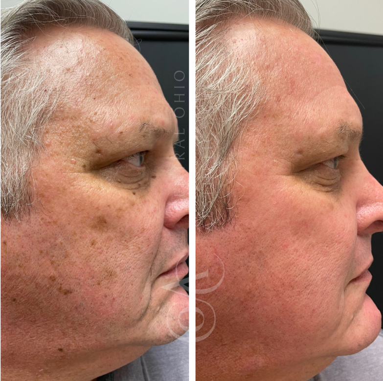 Side-by-side images of a man's face show a noticeable reduction in dark spots and smoother skin on the right side, highlighting improved complexion.