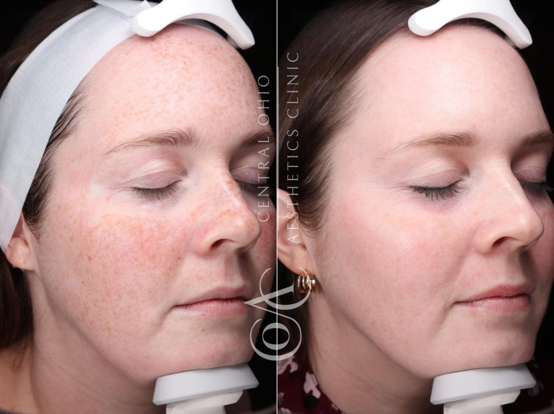 Before and after photos of a woman showcasing her freckles, highlighting a transformation in her appearance.