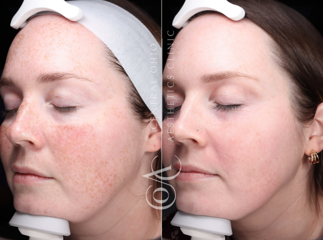 Woman's face showing red spots before treatment, and a clear complexion after treatment, highlighting the improvement.