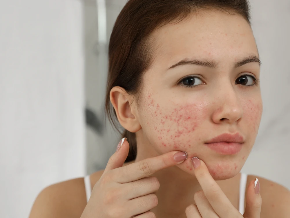 Young person with acne-prone skin looking in the mirror, gently touching facial blemishes. The expression is neutral, suggesting contemplation. Young person with acne-prone skin looking in the mirror, gently touching facial blemishes. The expression is neutral, suggesting contemplation.