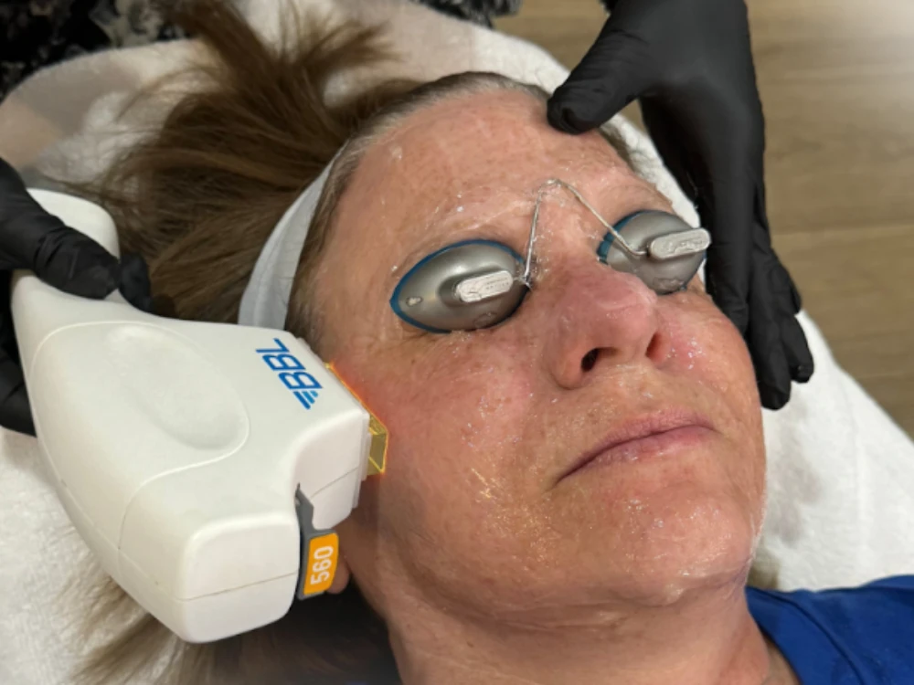A person receives a laser skin treatment, wearing protective goggles. A technician, in black gloves, uses a BBL device on the person's cheek. The atmosphere is calm. A person receives a laser skin treatment, wearing protective goggles. A technician, in black gloves, uses a BBL device on the person's cheek. The atmosphere is calm.