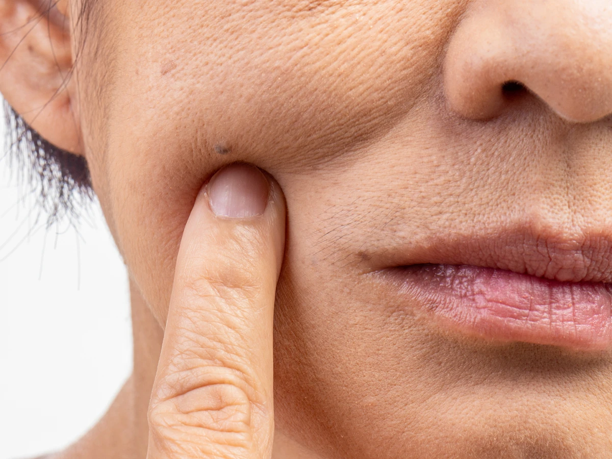 Cheek Filler Treatment in Powell, Oh