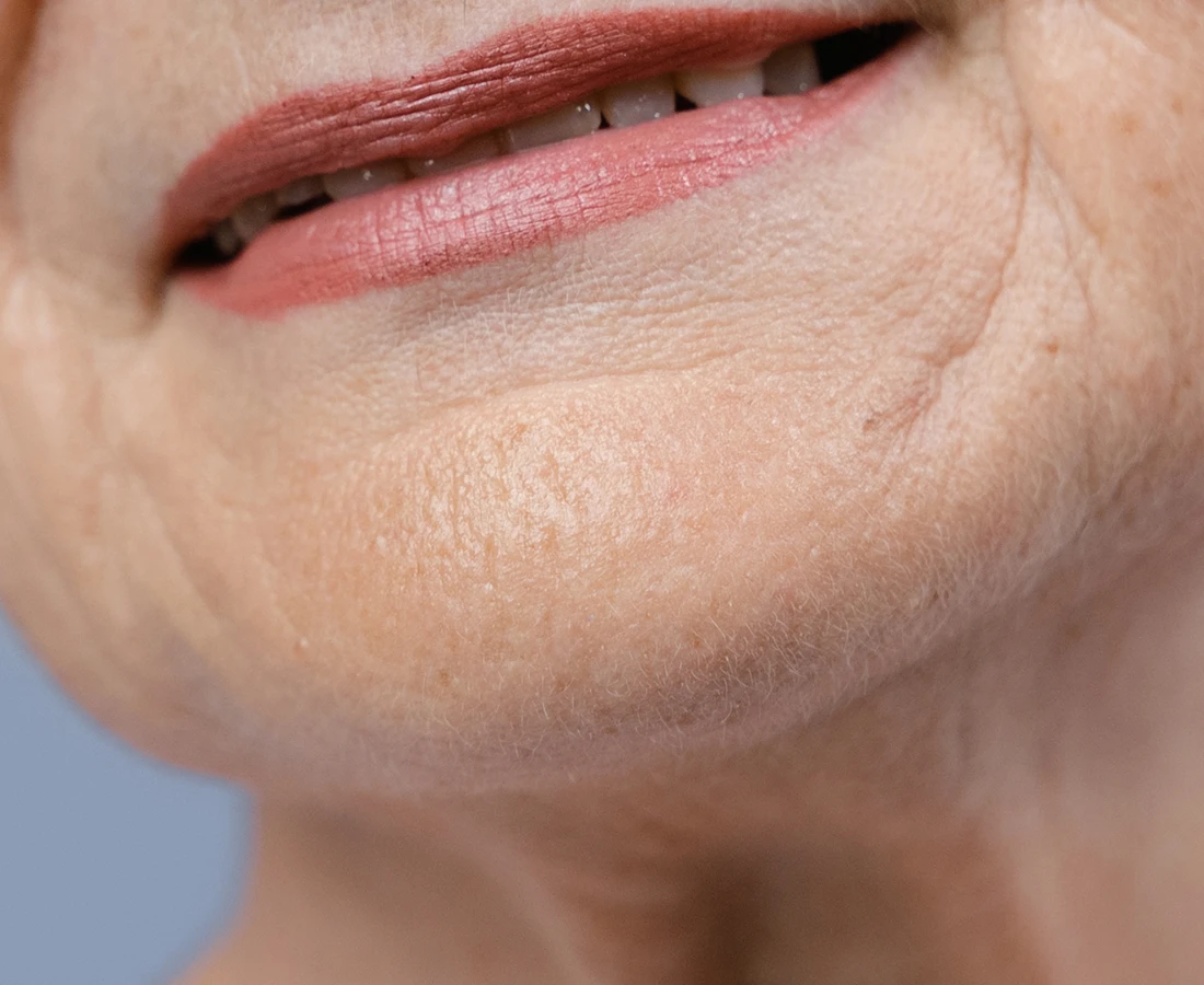 Chin Wrinkles Treatment in Powell, Oh
