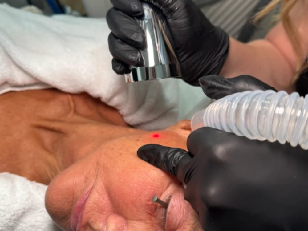 A person receives a skin treatment with a laser device on their cheek. They are covered in a white towel, while someone in black gloves holds the device, emitting a small red light. A person receives a skin treatment with a laser device on their cheek. They are covered in a white towel, while someone in black gloves holds the device, emitting a small red light.