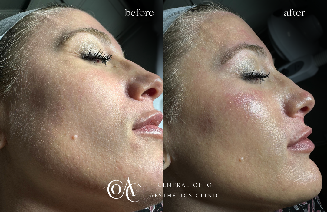 Dermaplaning Before and After