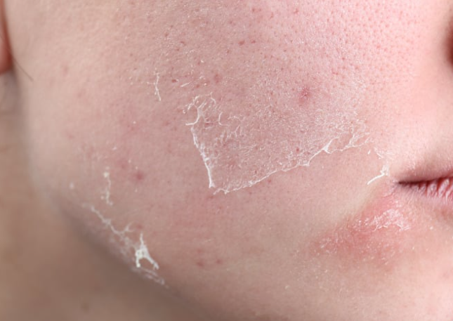 Dry or flaky skin