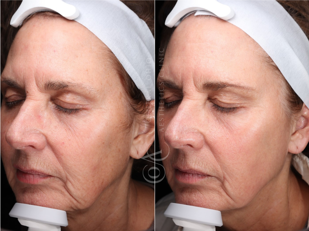 Before and after photo showing a woman with reduced wrinkles, highlighting the effects of skincare treatment.