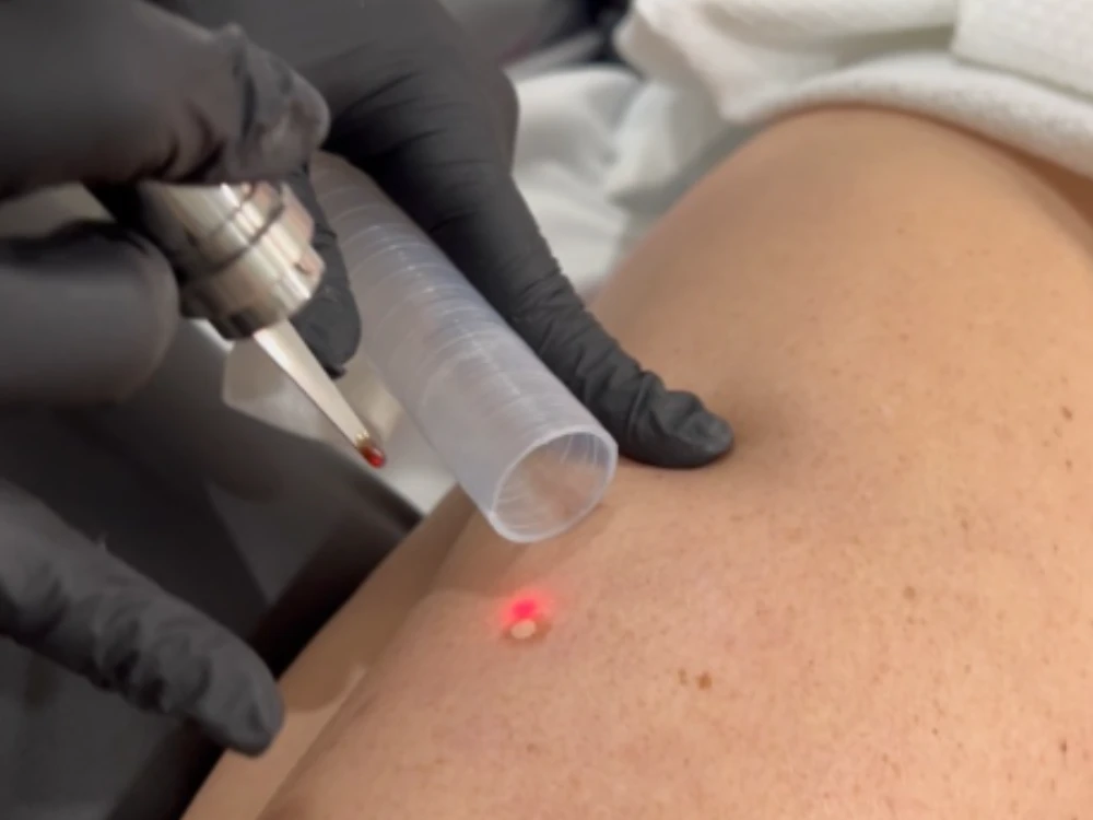 A gloved hand operates a laser tool on skin, targeting a mole with red light. The setting appears clinical, suggesting a medical procedure. A gloved hand operates a laser tool on skin, targeting a mole with red light. The setting appears clinical, suggesting a medical procedure.