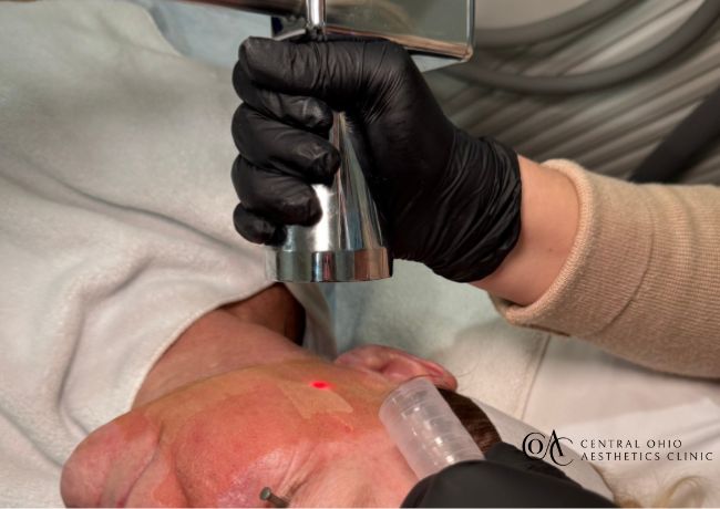MicroLaserPeel™ / Contour Resurfacing Laser™