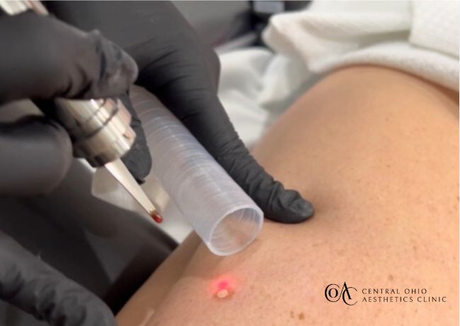 MicroLaserPeel™ Spot Treatment