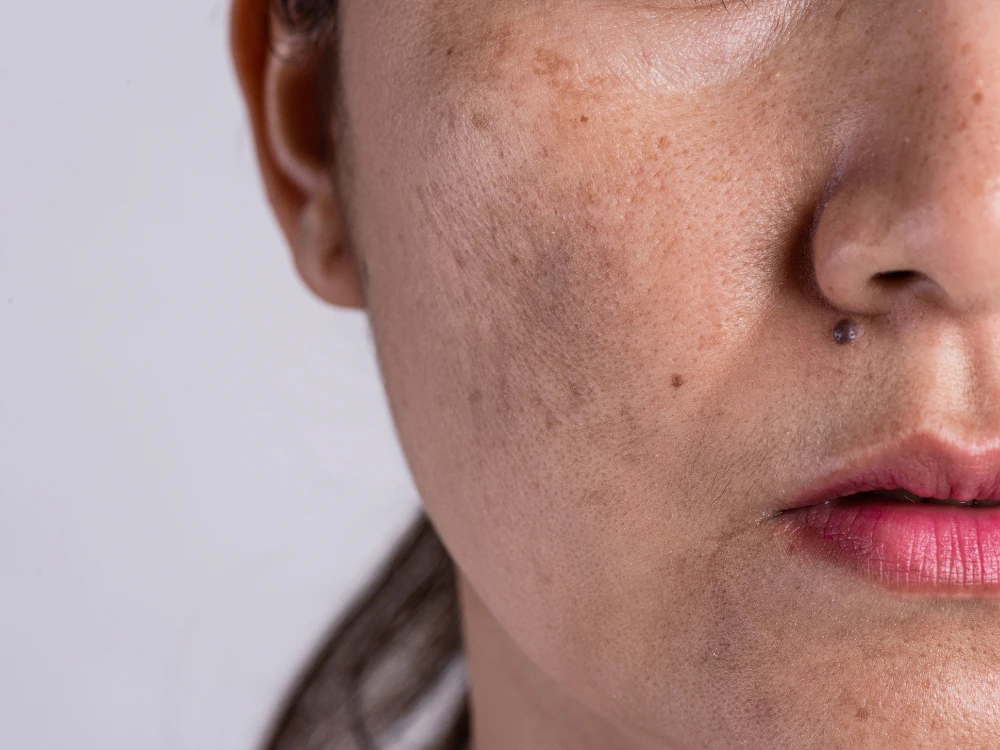 Close-up of a woman's face showing acne scars and skin blemishes. Her lips are slightly parted, wearing pink lipstick, on a neutral background. Close-up of a woman's face showing acne scars and skin blemishes. Her lips are slightly parted, wearing pink lipstick, on a neutral background.