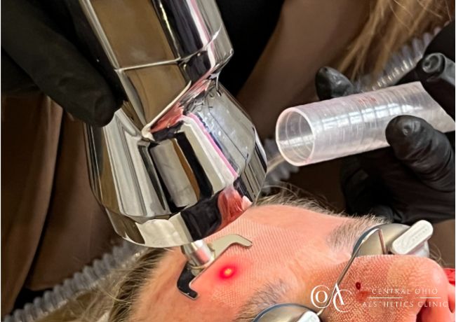 ProFractional™ Laser
