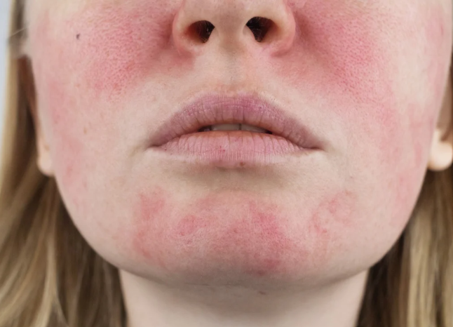 Redness and sensitivity