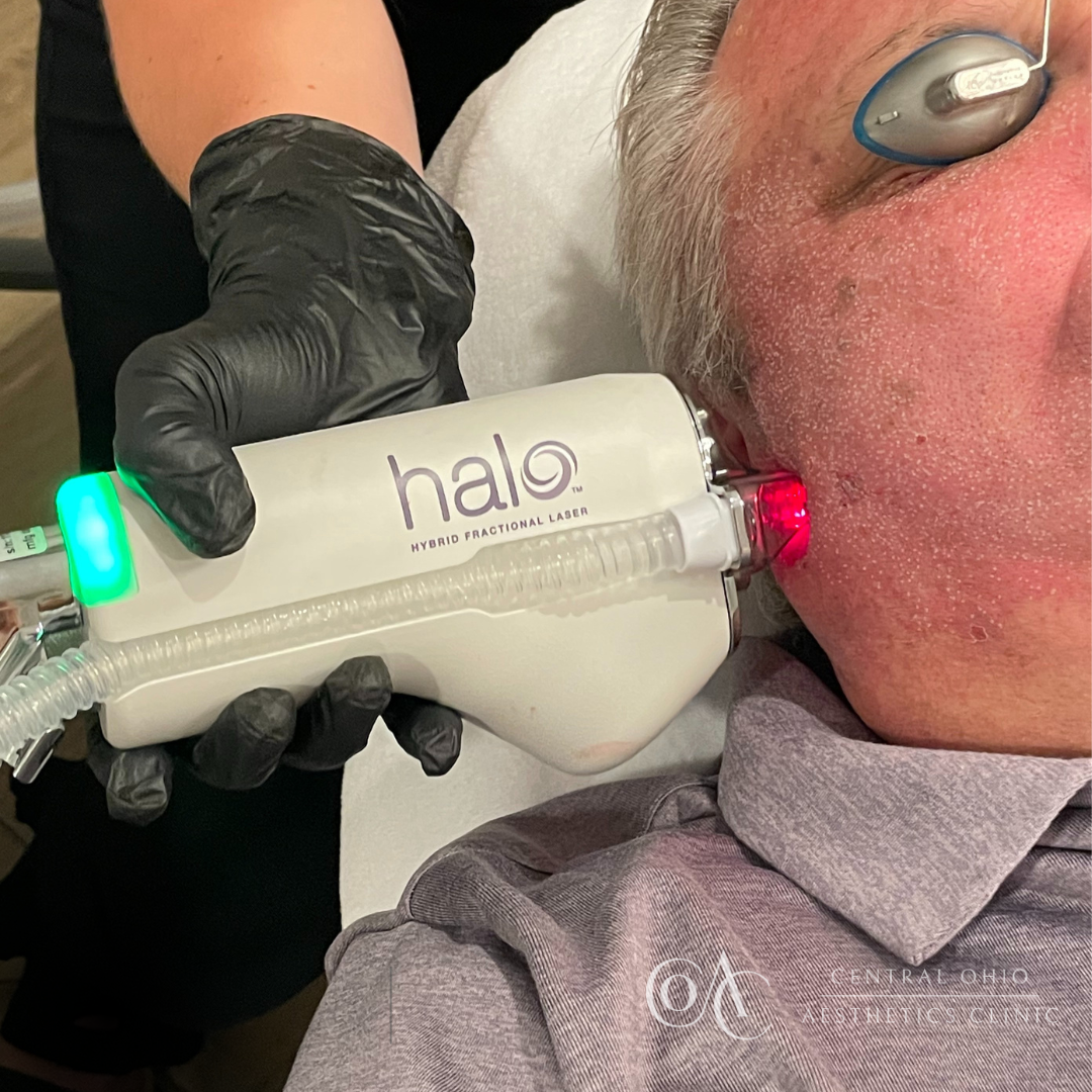 A man receiving a hair cut using a Halo Laser treatment in a clinic setting, showcasing advanced skin rejuvenation technology.