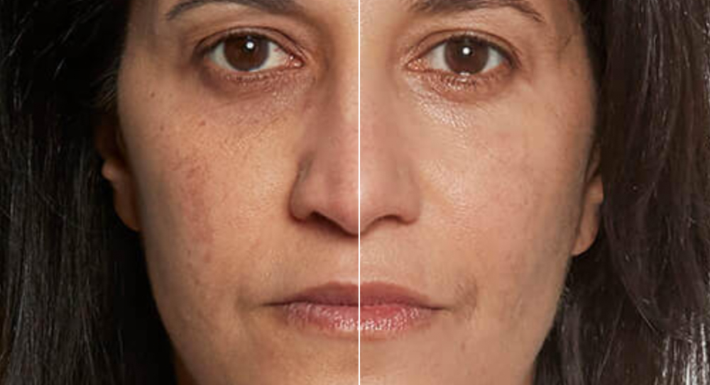 woman's wrinkles face before and after
