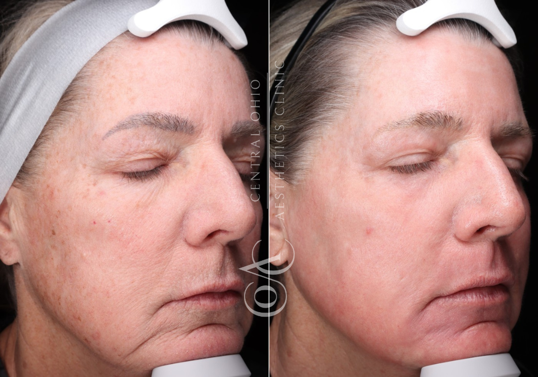 Laser Skin Resurfacing Before and After