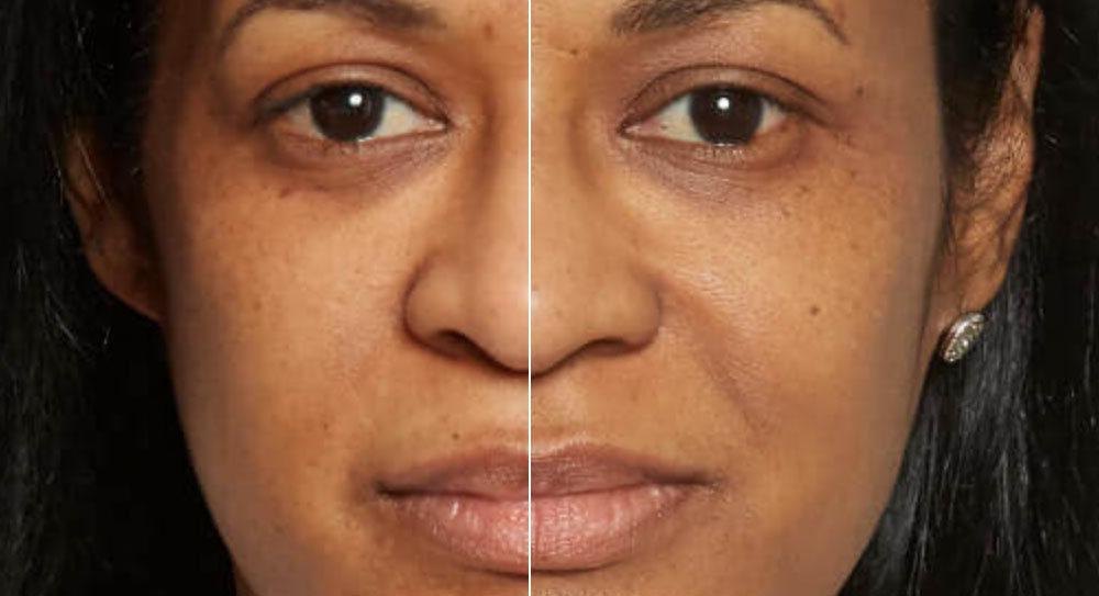 Central Ohio Aesthetics Sculptra