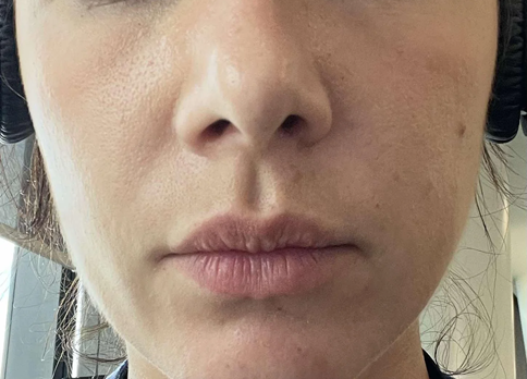 cheek-filler-for-volume-loss-advice-v0-q6bp9fty1eme1 A woman wearing headphones, with a focused expression, appears to be listening intently.