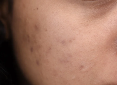 A woman with visible acne on her face, showcasing a range of skin textures and tones.