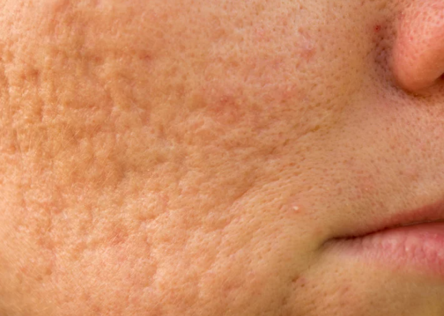 A close-up of a woman's face showing visible acne on her cheeks and forehead, highlighting skin texture and imperfections.