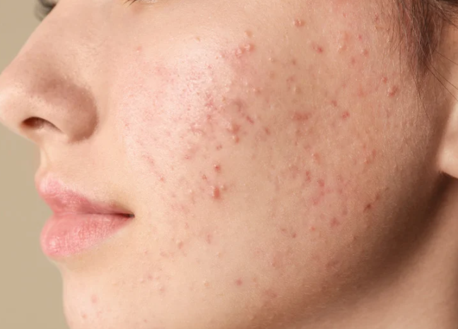 Close-up of a woman's face showing acne on her cheeks and forehead, highlighting skin texture and imperfections.