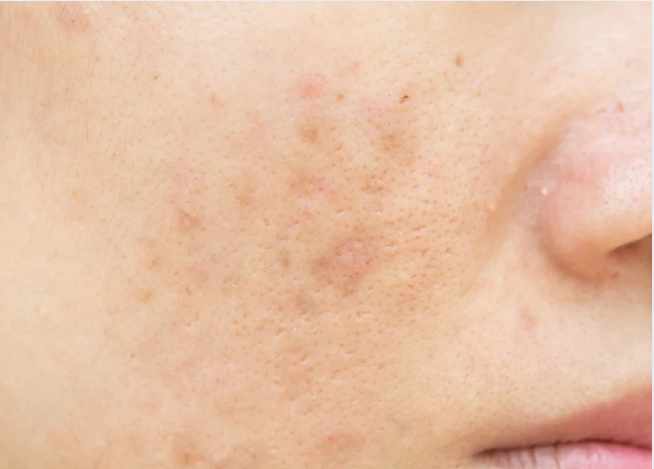 A woman with visible acne on her face, looking directly at the camera with a neutral expression.