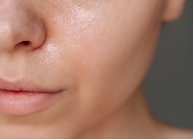 A woman with significant acne on her face, showcasing various blemishes and skin texture.