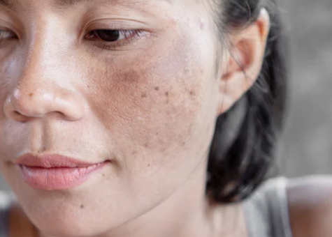 A woman with a freckled face smiles softly, showcasing her natural beauty and unique skin texture.