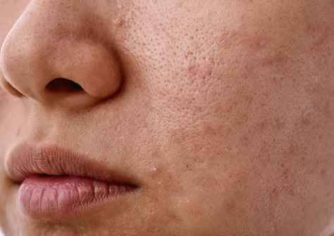 Close-up of a woman's face showing acne, highlighting skin texture and imperfections.
