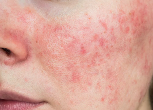 Close-up of a woman's face showing acne on her cheeks and forehead, highlighting skin texture and imperfections.